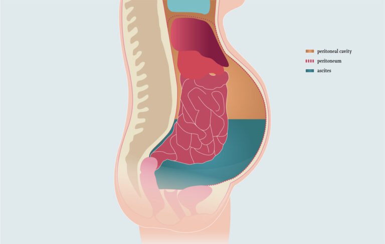 ascites-letshomeopathy