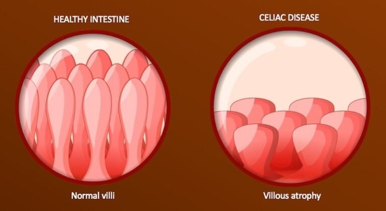 celiac-disease-letshomeopathy